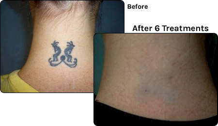 tattoo-removal-questions