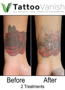 Before and After All Natural Tattoo Removal