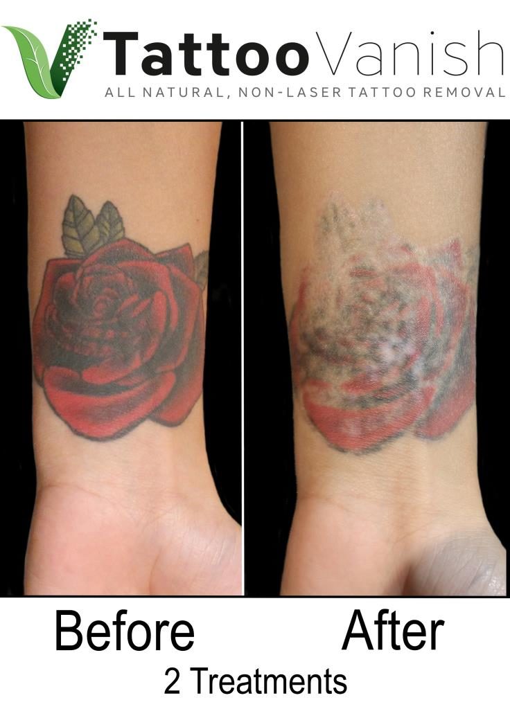 Tattoo Removal & Cost | Dr. Lawrence Desjarlais Dermatology | Adrian, MI