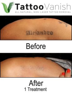 Best All Natural Tattoo Removal Results