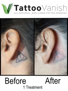 Tattoo Removal Results After 1 Treatment