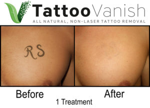 Before and After Tattoo Removal