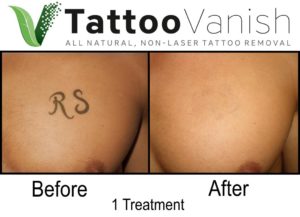 Before and After Natural Tattoo Removal