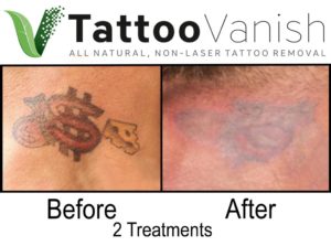 Best Tattoo Removal Results
