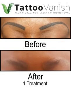 Before and After Eyebrow Tattoo Removal