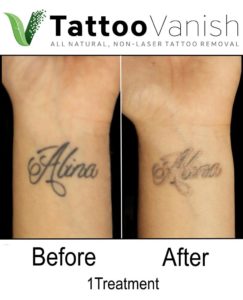 Before and After Tattoo Vanish