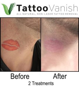 Tattoo Vanish Before and After
