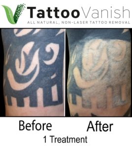Natural Tattoo Removal Before and After