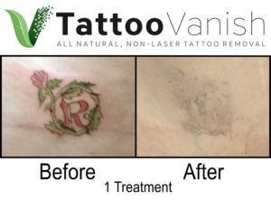 Tattoo Removal Before and After