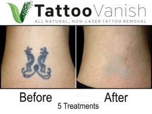 Laser Tattoo Removal Results vs. Tattoo Vanish Results