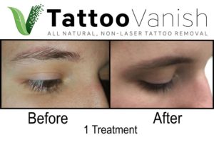 Eyebrow Tattoo Removal Before and After
