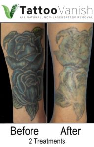 Natural Tattoo Removal Before After