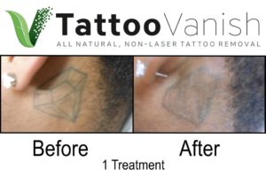 Best All Natural Tattoo Removal Method