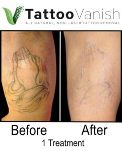 Best Non-Laser Tattoo Removal Results