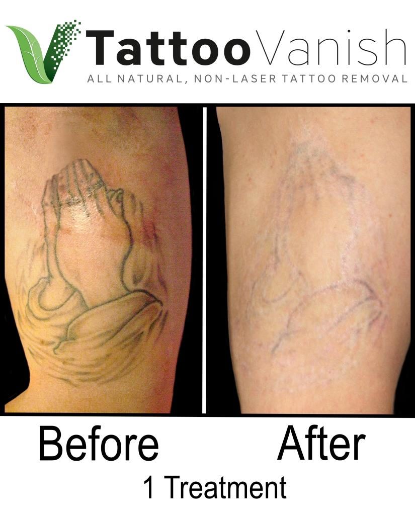 Before and After Tattoo Removal - Get the Best Results the All-Natural Way  | Tattoo Removal Pictures & Photos | Tattoo Vanish