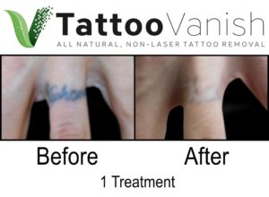 Tattoo Removal With The Tattoo Vanish Method