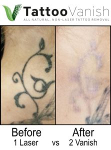 Laser Tattoo Removal vs Tattoo Vanish Method