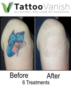 Before and After Tattoo Removal With Tattoo Vanish