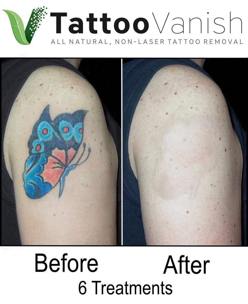 Laser Tattoo Removal | AACDS