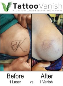 Best All Natural Tattoo Removal Method
