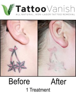 Tattoo Removal Results With Tattoo Vanish