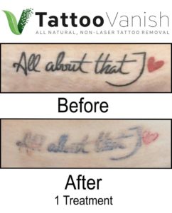 After Non-Laser Tattoo Removal