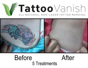 After All Natural Tattoo Removal