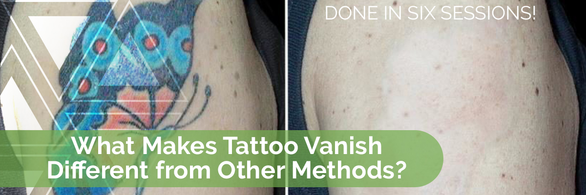 Tattoo Vanish is better than laser removal, for example, because laser hardens the skin and it’s much more difficult to apply new ink to laser treated skin.