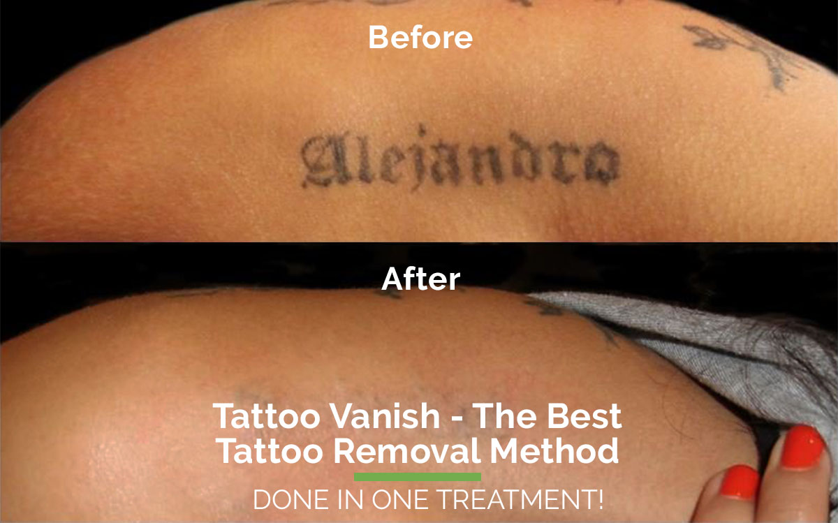 Laser Tattoo Removal South Walton - Tattoo Removal 30A