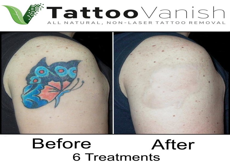 THE BEST 10 Tattoo Removal near Wynwood Miami FL 33127  Last Updated  January 2023  Yelp