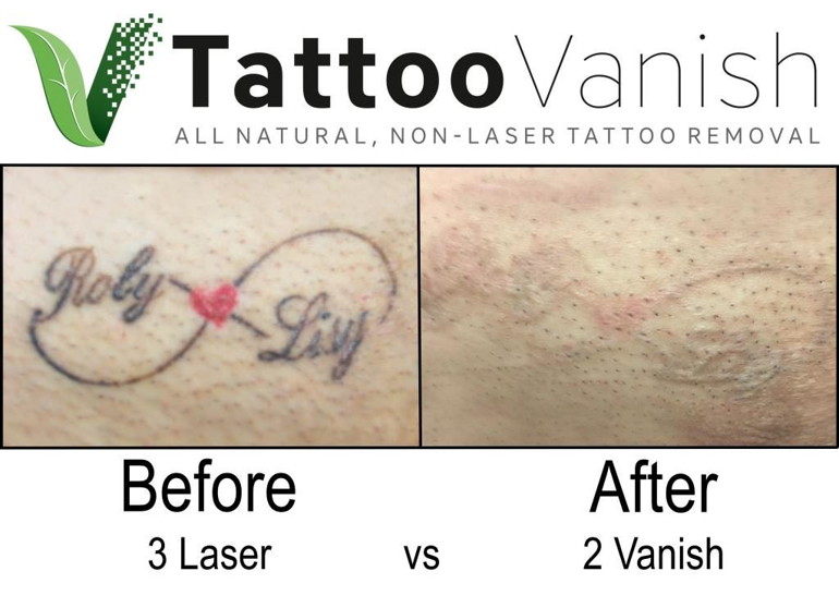 How to Remove Permanent Tattoo 10 Effective Ways to Try