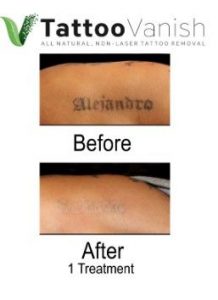 Tattoo Removal Training